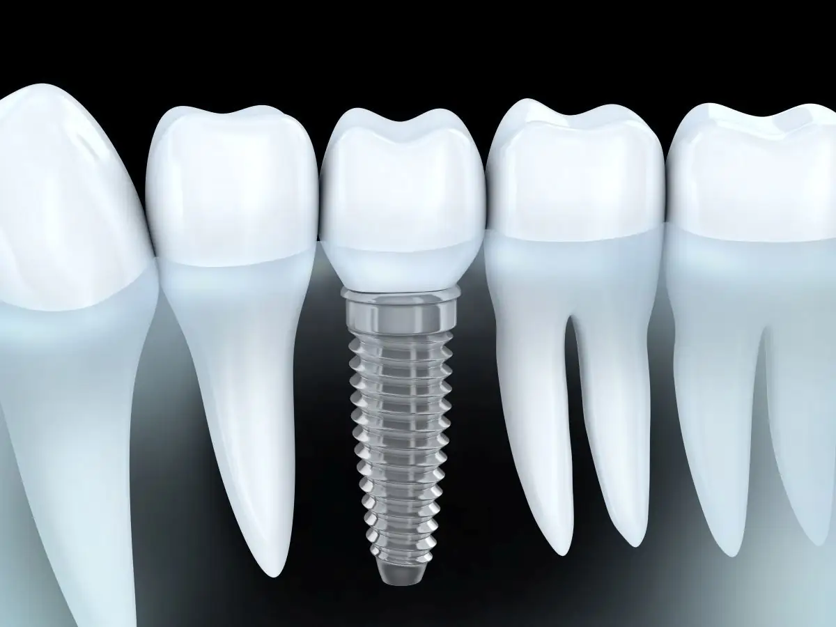 La historia de los implantes dentales
