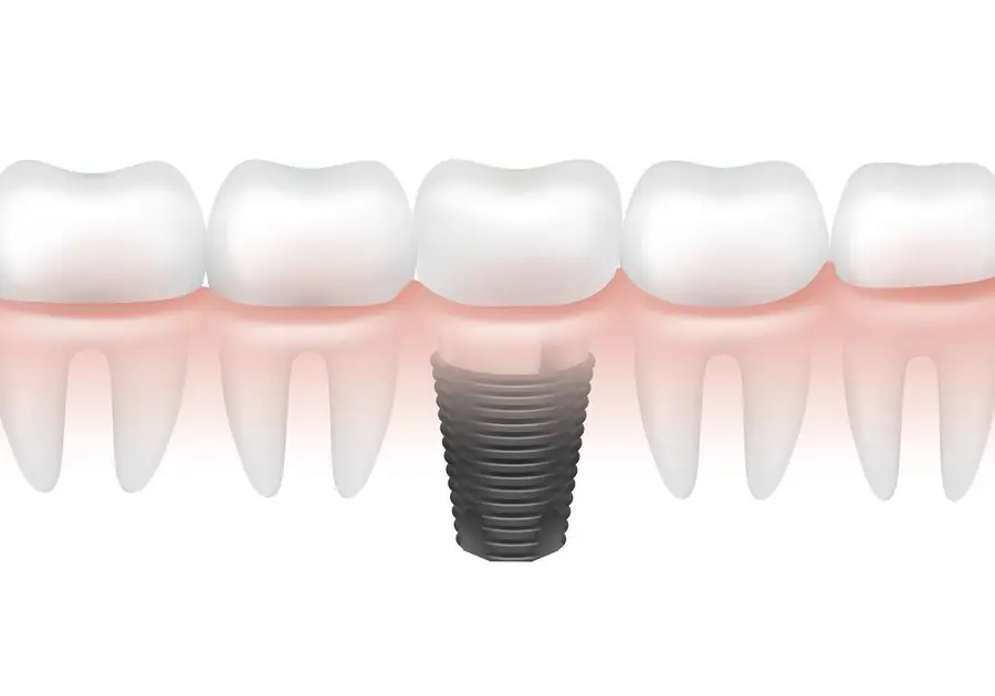 Implantes dentales en Madrid Centro: solución eficaz para recuperar tu sonrisa