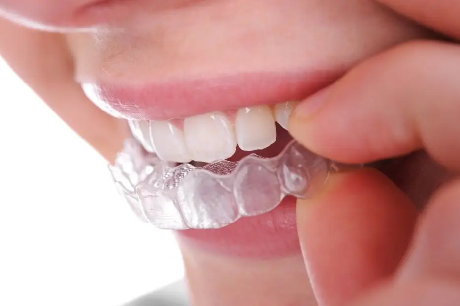 Ortodoncia invisible: La revolución de las sonrisas alineadas