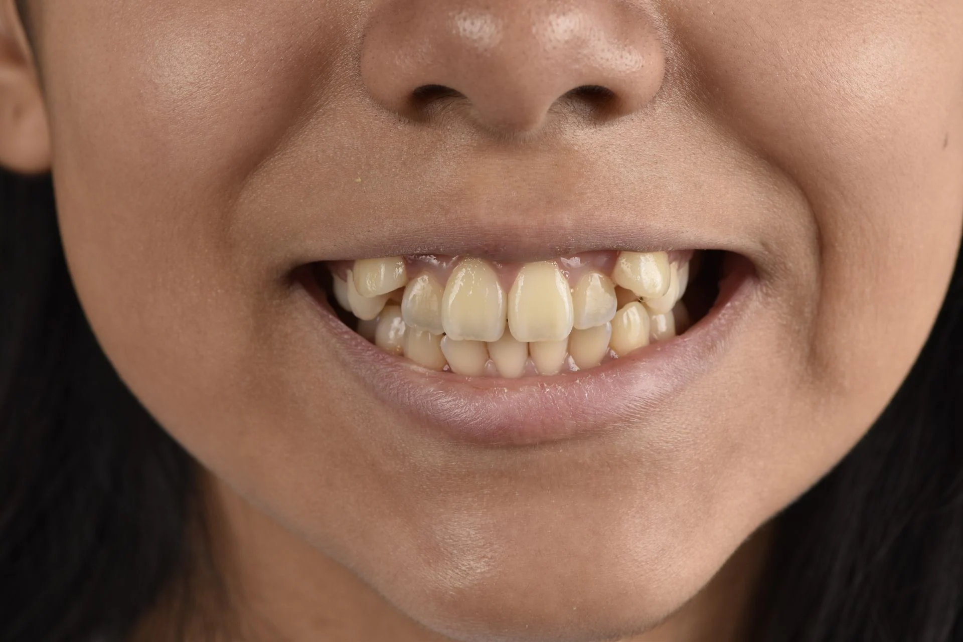 Sonrisa antes de un tratamiento de ortodoncia en Clínica Santamaría