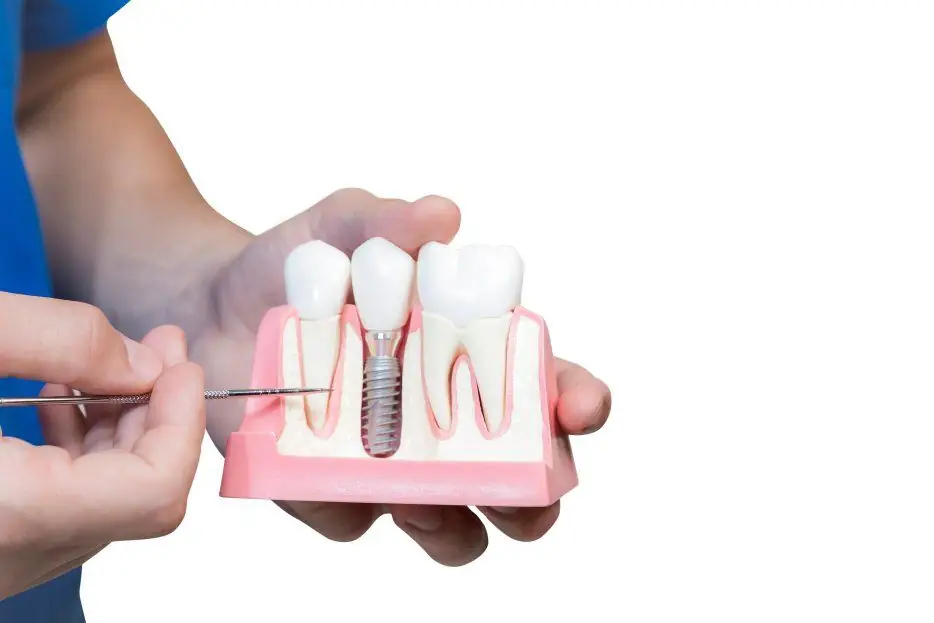 Implantes dentales: La clave para una sonrisa saludable y duradera