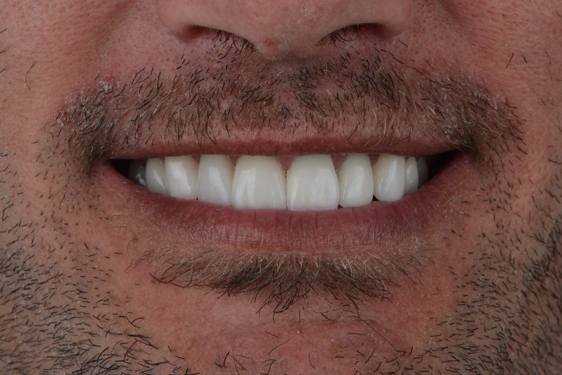 Resultado de una rehabilitación con prótesis dentales en Clínica Santamaría