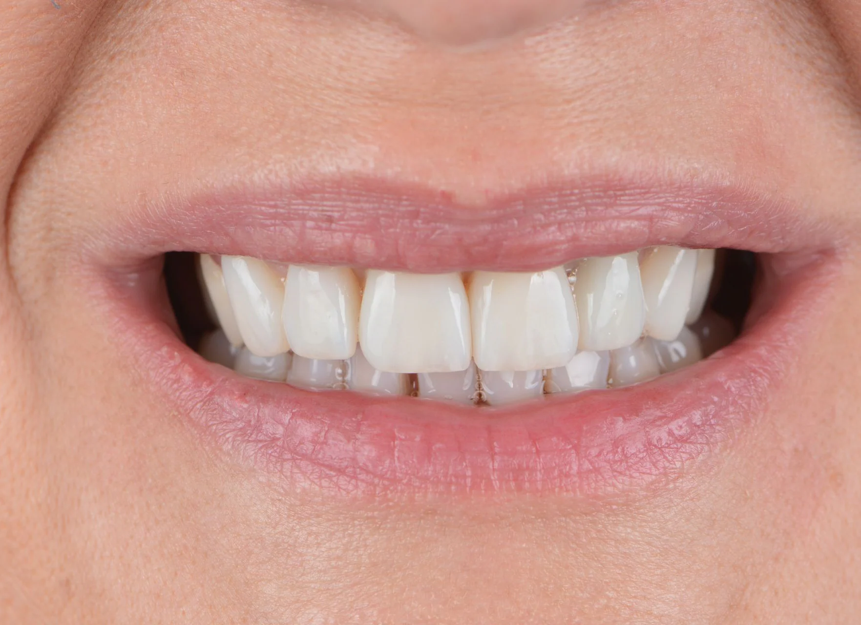 Resultado de un tratamiento de estética dental realizado en Clínica Santamaría